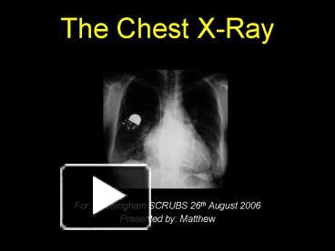 PPT – The Chest XRay PowerPoint Presentation | Free To View - Id ...