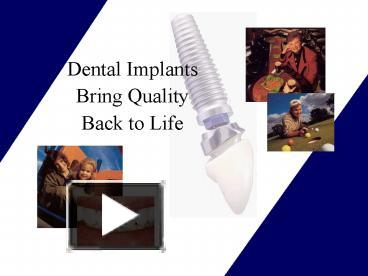 PPT – Dental Implants Bring Quality Back To Life PowerPoint ...