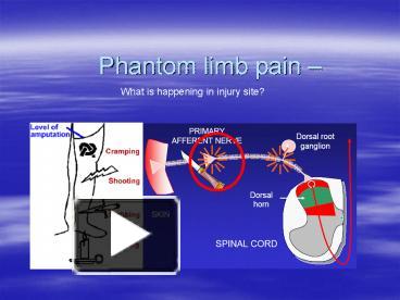 PPT – Phantom Limb Pain PowerPoint Presentation | Free To View - Id ...