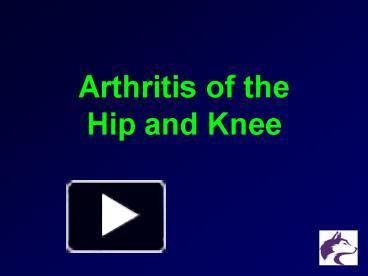 PPT – Arthritis Of The Hip And Knee PowerPoint Presentation | Free To ...