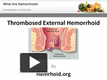 Learn about what thrombosed external haemorrhoid is and how you can avoid the excruciating pain associated with this common condition. – A free PowerPoint PPT presentation (displayed as an HTML5 slide show) on PowerShow.com - id: 3a97e4-NTUxM