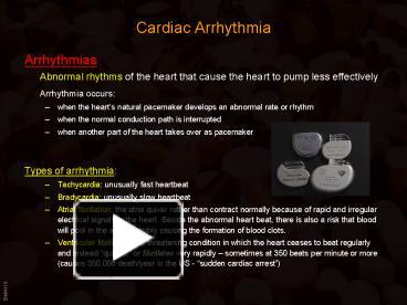 PPT – Cardiac Arrhythmia PowerPoint Presentation | Free To View - Id ...