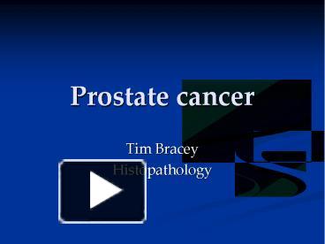 PPT – Prostate Cancer PowerPoint Presentation | Free To Download - Id ...