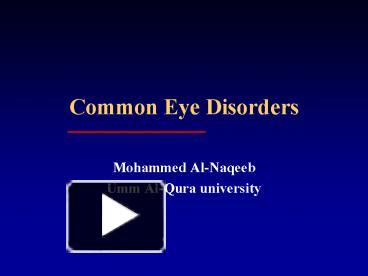 PPT – Common Eye Disorders PowerPoint Presentation | Free To View - Id ...