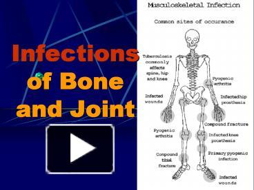 PPT – Infections Of Bone And Joint PowerPoint Presentation | Free To ...