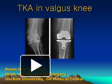 Ppt Tka In Valgus Knee Powerpoint Presentation Free To View Id E Odrkm