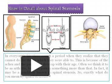 PPT – Cervical Spinal Stenosis PowerPoint Presentation | Free To ...