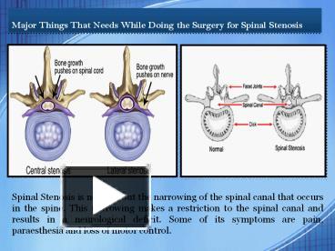 PPT – Surgery For Spinal Stenosis PowerPoint Presentation | Free To ...