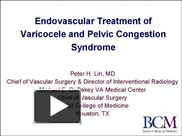 PPT – Endovascular Treatment Of Varicocele And Pelvic Congestion ...