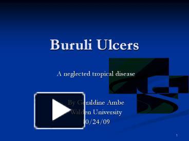 PPT – Buruli Ulcers PowerPoint Presentation | Free To Download - Id ...