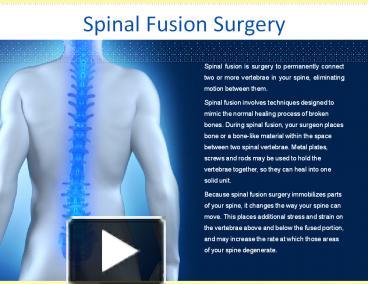 PPT – Spinal Fusion Surgery PowerPoint Presentation | Free To Download ...