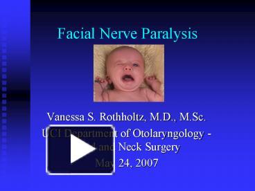 Ppt – Facial Nerve Paralysis Powerpoint Presentation 