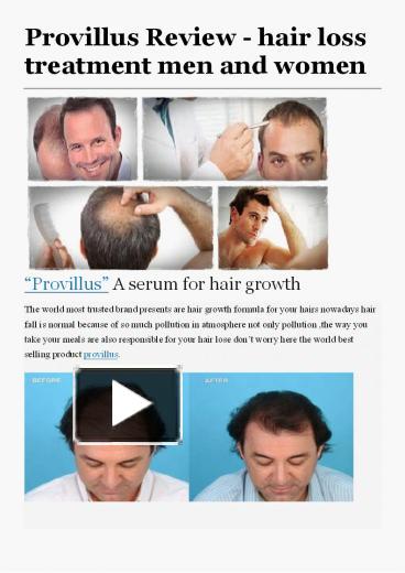 Ppt Provillus Review Hair Loss Treatment Men And Women Powerpoint