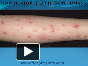 PPT Flea Bites Symptoms Prevention Treatment PowerPoint Presentation Free To Download