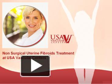 PPT – Non Surgical Uterine Fibroids Treatment - USA Vascular Centers ...