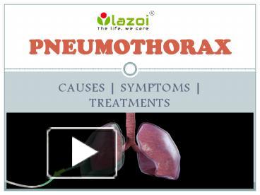 PPT – Pneumothorax : Causes, Symptoms, Diagnosis And Treatment ...