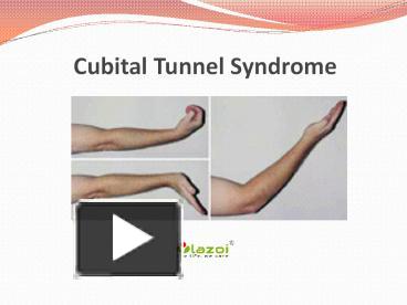 PPT Cubital Tunnel Syndrome Causes Symptoms Diagnosis And