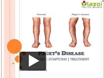 PPT Pagets Disease Causes Symptoms Diagnosis And Treatment