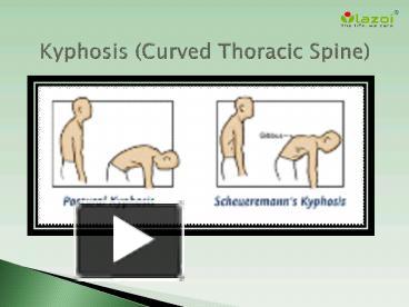 Ppt Kyphosis Curved Thoracic Spine Symptoms Types Causes And Treatment Powerpoint