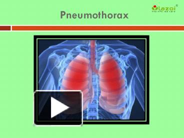 Ppt Pneumothorax Symptoms Causes Diagnoses And Treatment