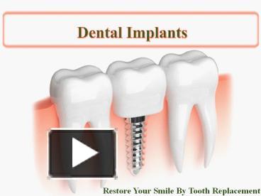 Ppt A Complete Guide To Dental Implants Treatment Powerpoint Presentation Free To Download