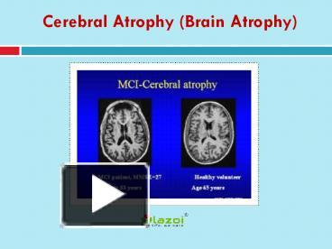 PPT – Cerebral Atrophy (Brain Atrophy): Learn About Symptoms, Causes ...