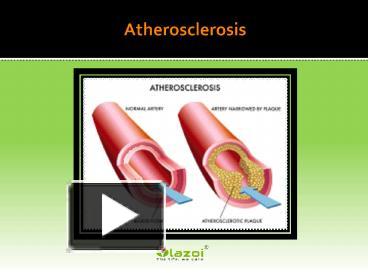 PPT – Atherosclerosis : Causes, Symptoms, Diagnosis And Treatment ...