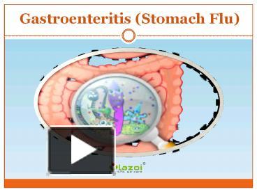 PPT – Gastroenteritis (Stomach Flu): Symptoms, Causes, Diagnosis And ...