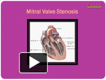 PPT – Mitral Valve Stenosis: Causes, Symptoms, Daignosis, Prevention ...