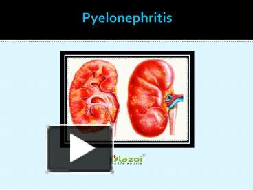 PPT – Pyelonephritis: Causes, Symptoms, Daignosis, Prevention And ...