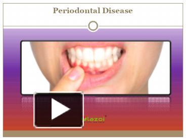 PPT What Is Periodontal Disease Read More About Symptoms And