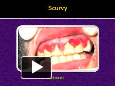 PPT – Scurvy: Causes, Symptoms, Daignosis, Prevention And Treatment ...