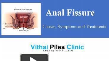 Ppt Anal Fissure Causes Symptoms And Treatments Powerpoint