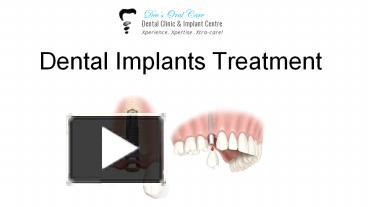 PPT Dental Implants In Pune Dev S Oral Care PowerPoint Presentation Free To Download