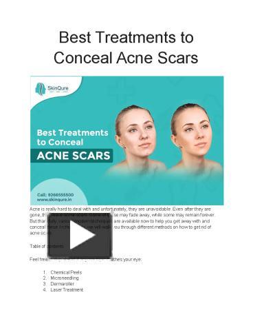 Ppt Best Treatments To Conceal Acne Scars Powerpoint Presentation