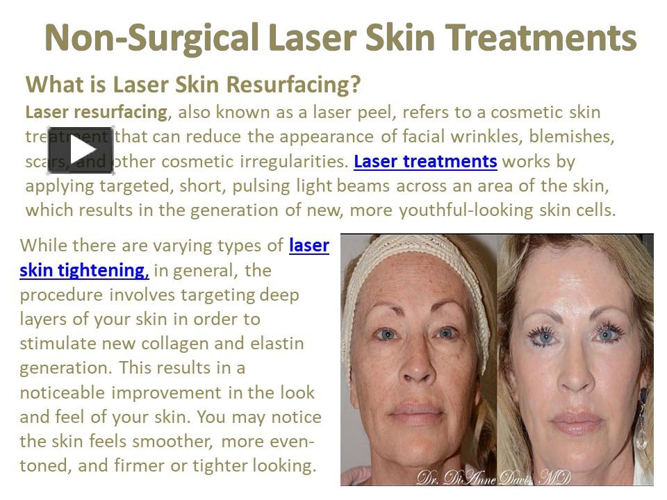 Ppt Non Surgical Laser Skin Treatments Powerpoint Presentation Free