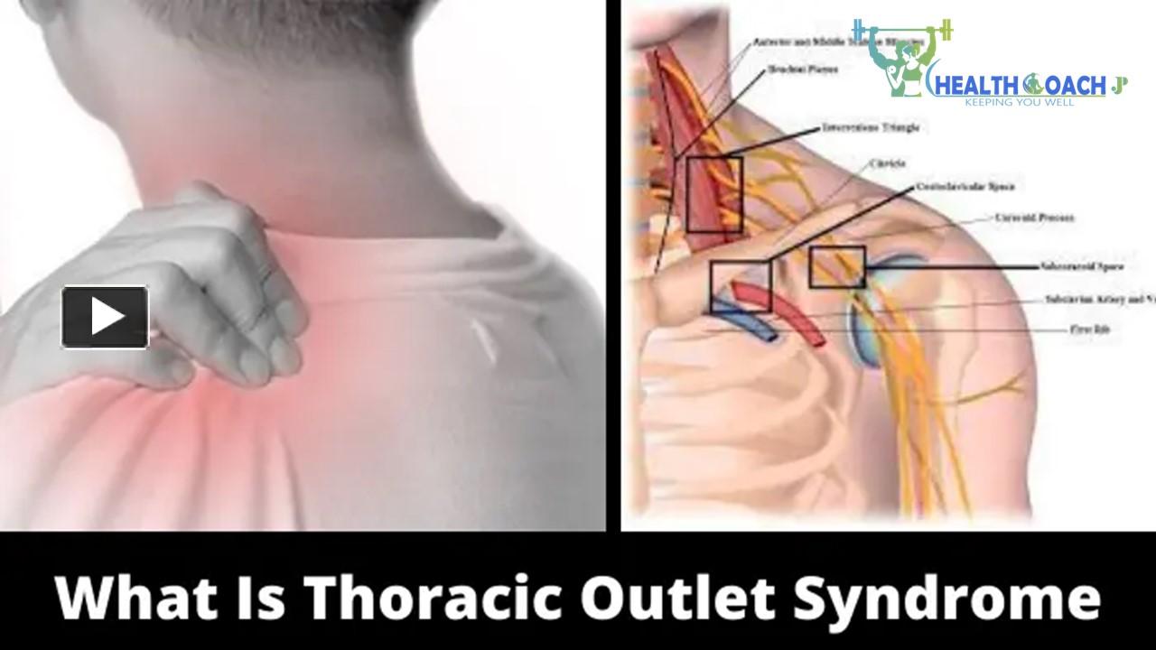 Ppt Stretching Exercises For Thoracic Outlet Syndrome Treatment Powerpoint Presentation Free