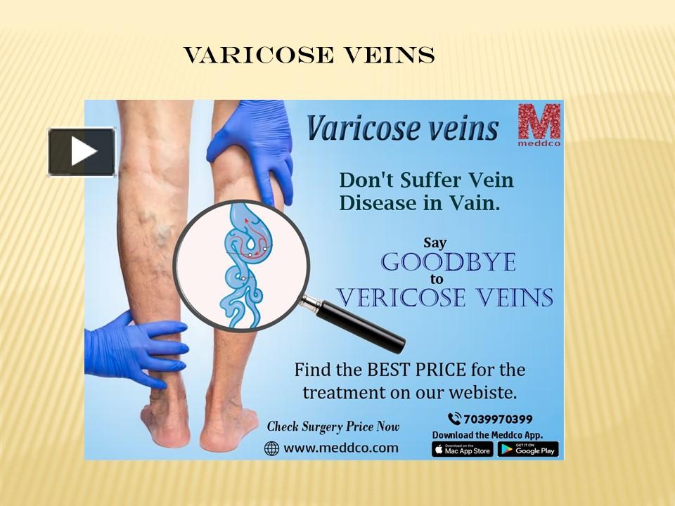 anatomy and physiology of varicose veins ppt