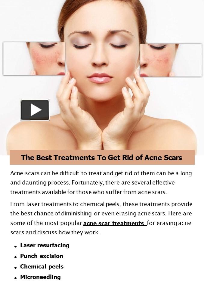 PPT The Best Treatments To Get Rid Of Acne Scars PowerPoint