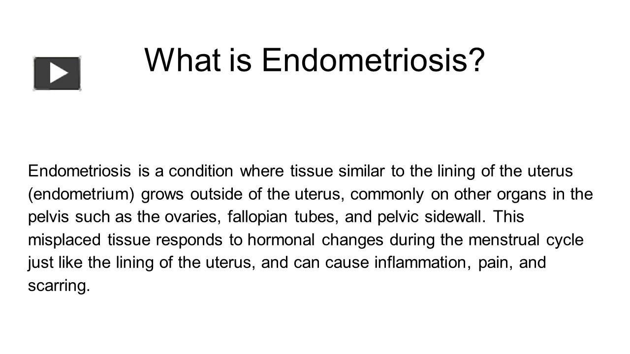 PPT – Endometriosis Treatment PowerPoint Presentation | Free To ...