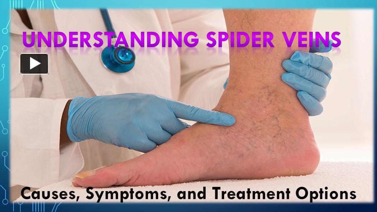 Ppt Understanding Spider Veins Causes Symptoms And Treatment Options Powerpoint Presentation 6141