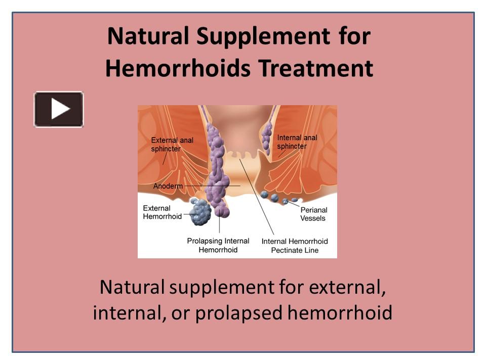 Ppt Cure Piles Anal Fissure Hemorrhoids Completely Powerpoint