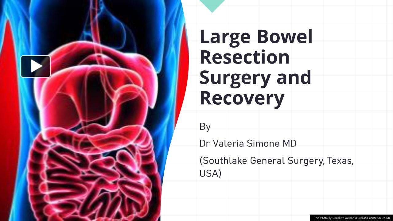 Ppt Large Bowel Resection Surgery And Recovery Powerpoint