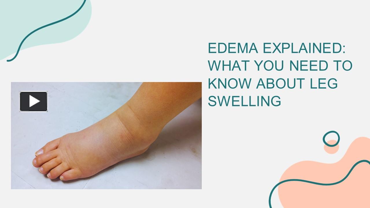 PPT Leg Edema Treatment In Coimbatore Leg Swelling Doctor In