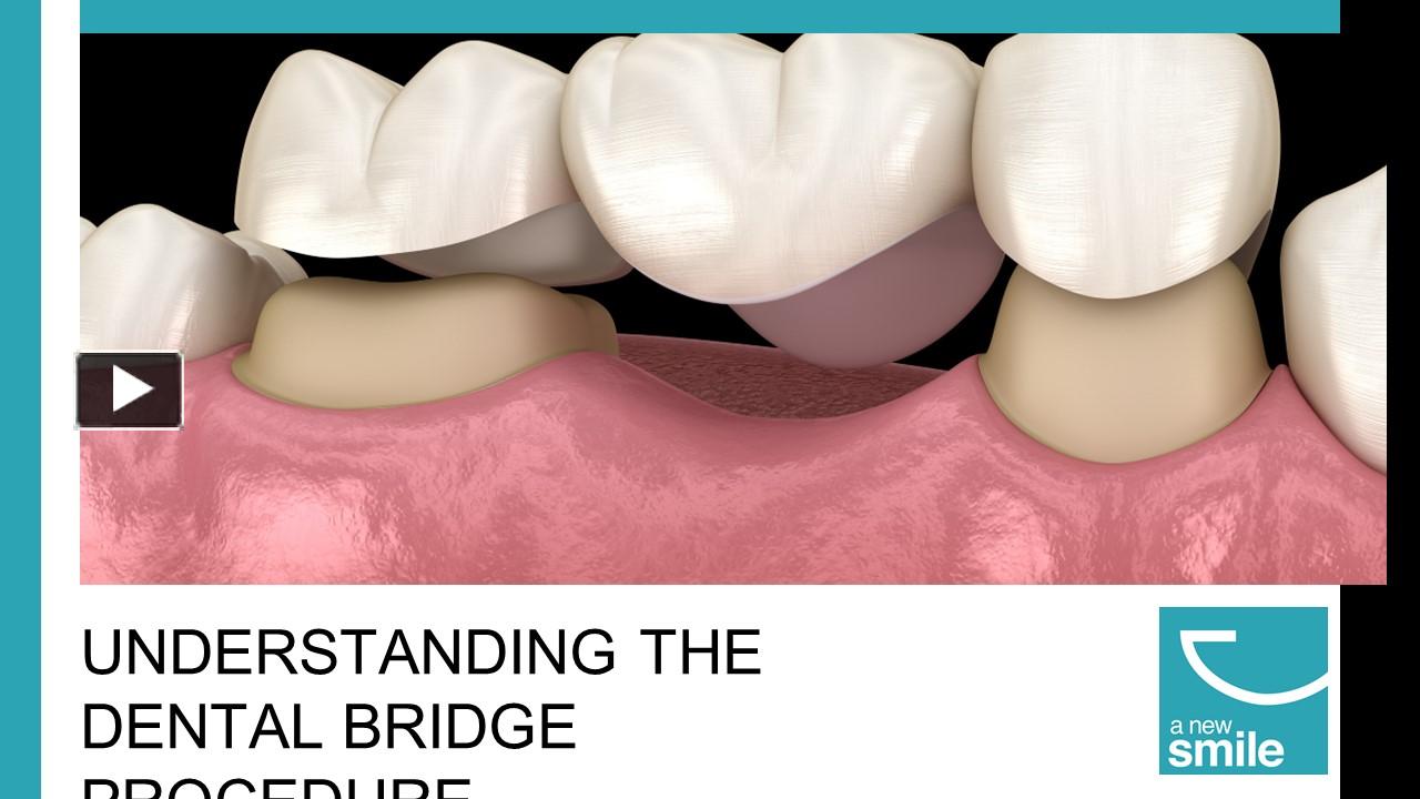 PPT Rediscover Your Smile With A Dental Bridge PowerPoint