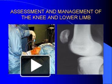 PPT – ASSESSMENT AND MANAGEMENT OF THE KNEE AND LOWER LIMB PowerPoint ...