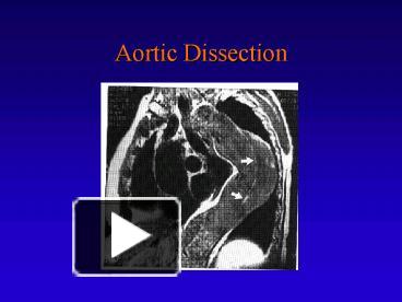 PPT – Aortic Dissection PowerPoint Presentation | Free To View - Id ...