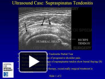 Ppt Ultrasound Case Supraspinatus Tendonitis Powerpoint Presentation