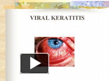 PPT – VIRAL KERATITIS PowerPoint presentation | free to view - id ...