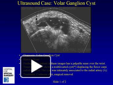 PPT – Ultrasound Case: Volar Ganglion Cyst PowerPoint presentation ...